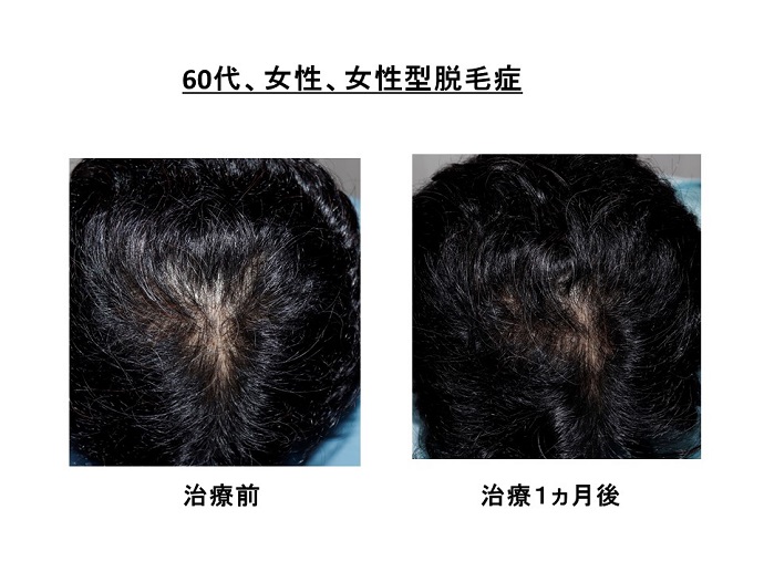 円形脱毛症　病院